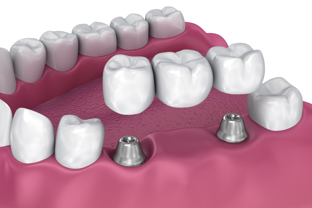 implant supported bridge